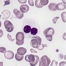Multiple Myeloma And MGUS Patients May Have An Increased Risk Of Developing Certain Cancers