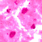 Shortage of Clinical Trial Participants Hinders War On Cancer