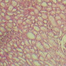 Kidney Failure In Multiple Myeloma Patients - Part 2: Treatment