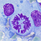 Perifosine Advances To Phase 3 Multiple Myeloma Clinical Trial