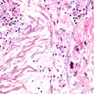 Itraconazole May Worsen Velcade-Induced Side Effects In Relapsed Multiple Myeloma Patients