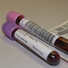 Heavy/Light Chain Ratios May Be A Prognostic Marker For Myeloma Patients