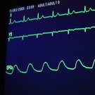 Stem Cell Transplants Linked To Higher Risk Of Irregular Heart Beat In Multiple Myeloma Patients
