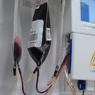 Study Finds Donor Lymphocyte Infusions Are More Effective When Used Preemptively In Myeloma Transplant Patients