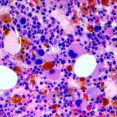 Zusätzliche Behandlung zur Vertiefung des Ansprechens vor Transplantation verbessert das Überleben bei neu diagnostiziertem multiplem Myelom nicht