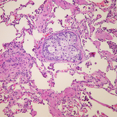 Pomalidomid kann bei Myelompatienten wirksam sein, die eine extramedulläre Manifestation des Myeloms entwickeln