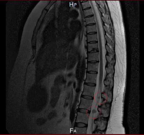 Tumors on Cauda Equina V2.png